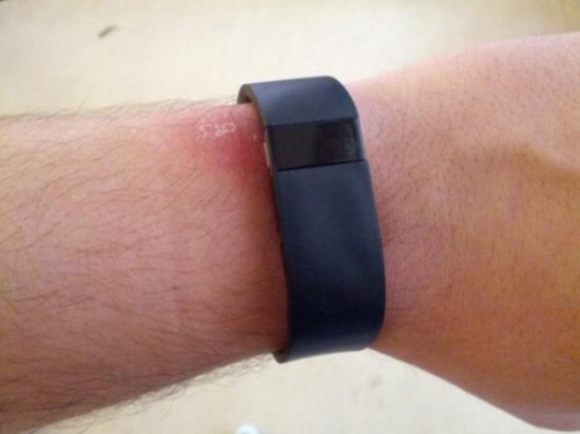 fitbit-force-wristband-irritation